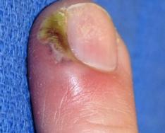 Отчего развивается и как нужно лечить воспалительный процесс около ногтя Вылечить пустоту под ногтем на руке